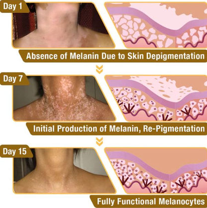 Fivfivgo™ BeeVenom Vitiligo ( 7 Days Result ) Treatment Cream- BUY 1 GET 1 FREE ⭐️⭐️⭐️⭐️ 4.9/5 Reviews