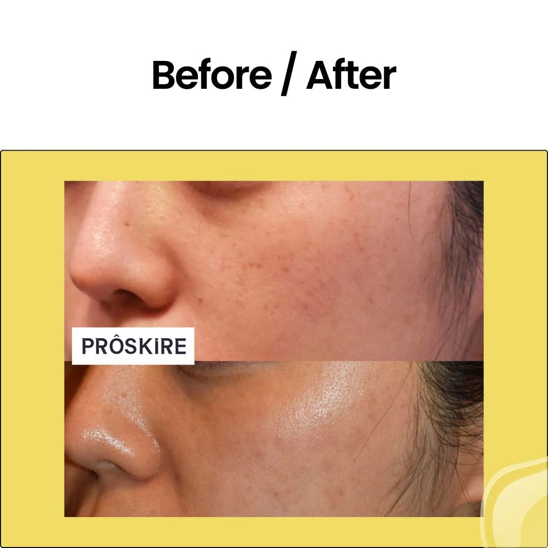 20% Advance Vitamin C Face Serum for Korean Skin 30ml | BUY 1 GET 1 FREE | ⭐️⭐️⭐️⭐️ 4.9/5 Reviews