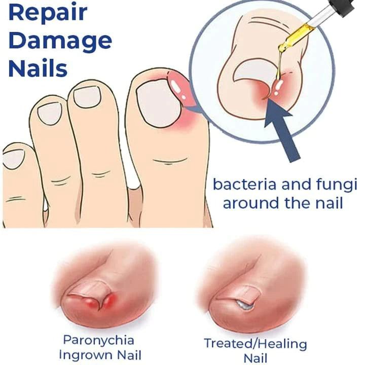 Anti Paronychia Relief Oil ( BUY 1 GET 1 FREE )